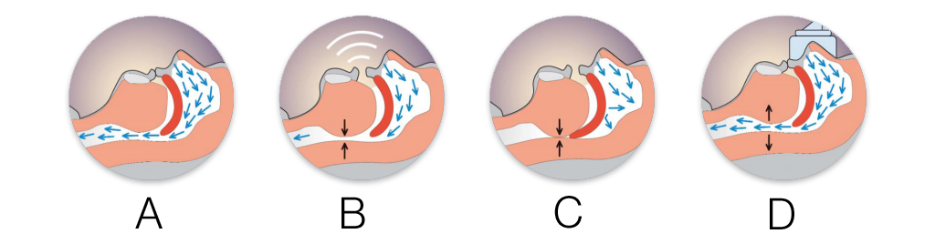 Four cross-sections of the upper airway during sleep: A, open and breathing normally; B, narrowed so the soft tissue vibrates and snoring results; C, completely blocked, stopping breathing; D, held open by the airflow from a PAP machine