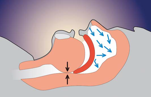 The same cross-section with the airway completely closed, no air moving through the throat