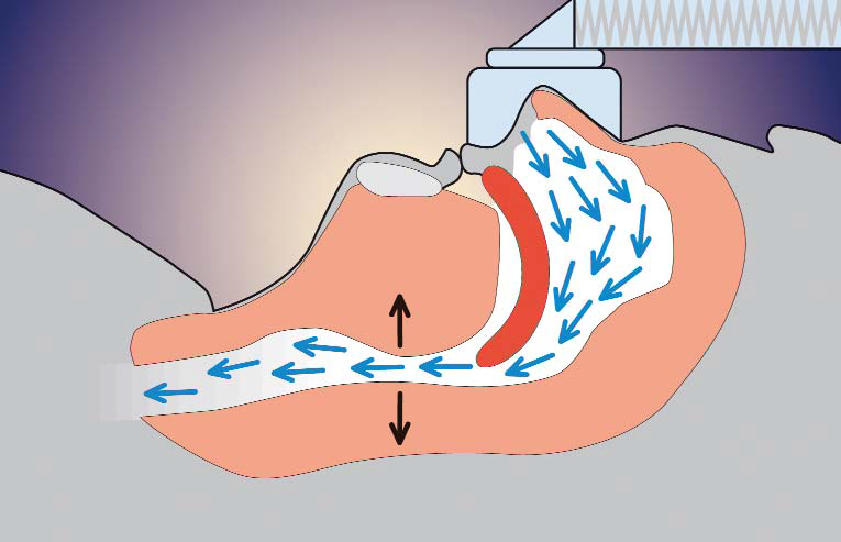 The same cross-section wearing a nasal CPAP mask connected to tubing, the airway held open and air flowing freely again