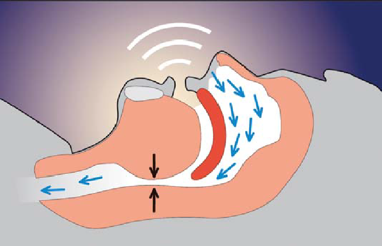The same cross-section with the airway narrowed by relaxed tissue, arrows marking the constriction and sound waves above the head indicating snoring