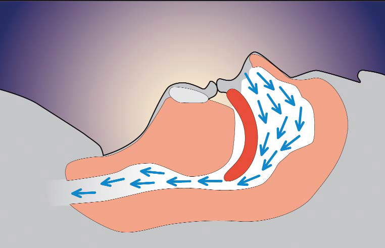 Cross-section of a sleeping head with an open upper airway, blue arrows showing air moving freely through the throat